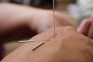 Akupunktura jako element leczenia w ponad 200 jednostkach chorobowych